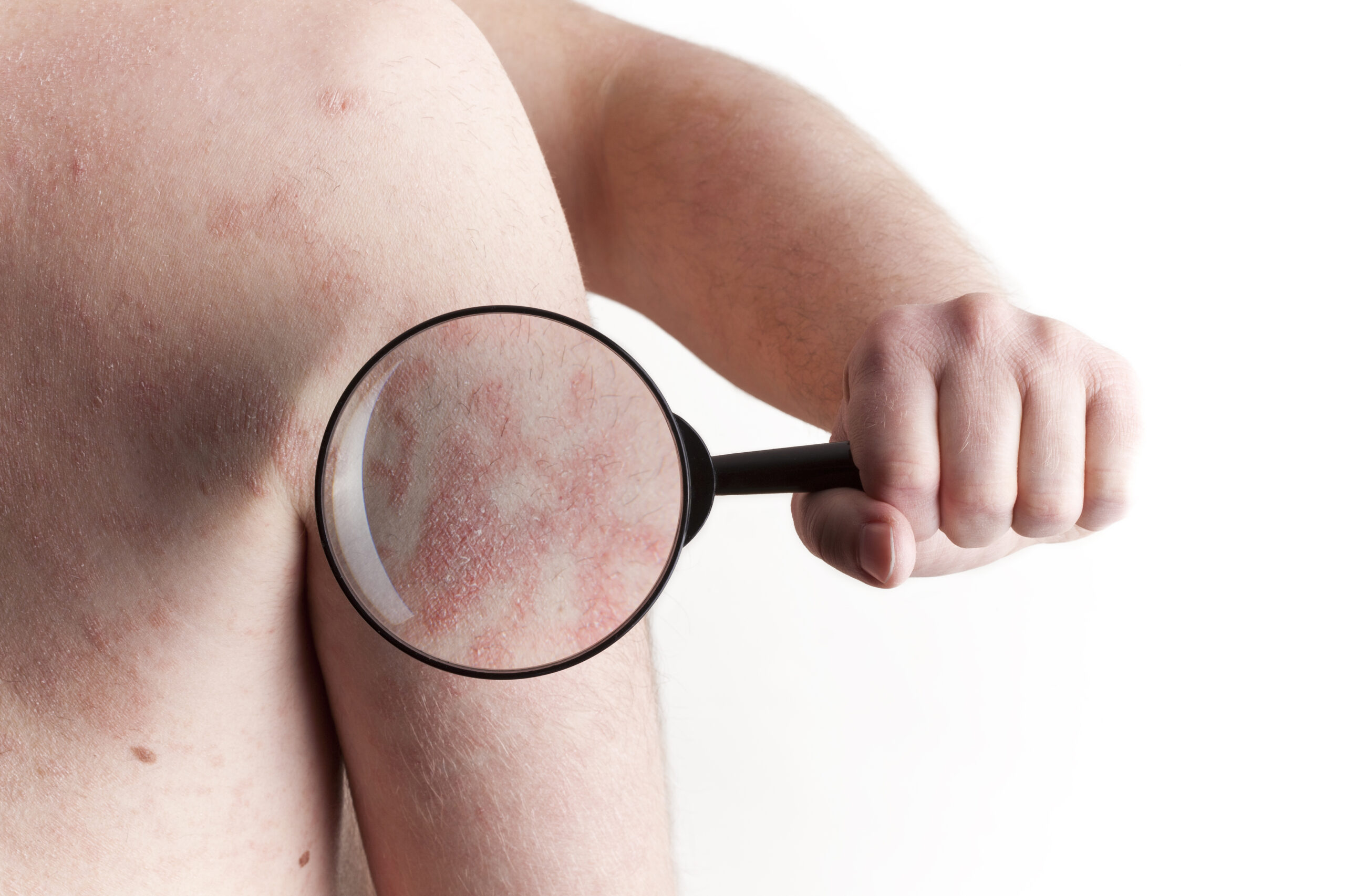 Checkbox Rash Rashes