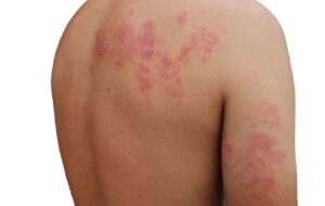 Shingles on a person's back